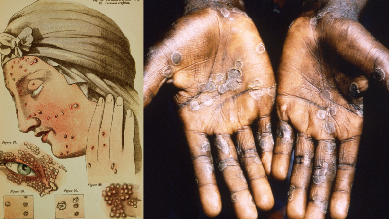 https://wbhm.org/wp-content/uploads/2024/10/small-mpox-diptych-800x450.png