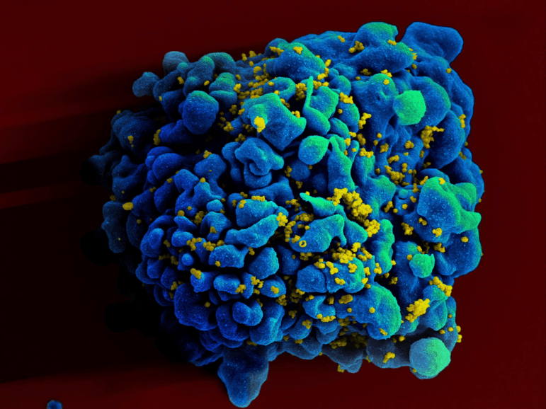 Scanning electromicrograph of an HIV-infected H9 T cell. Credit: NIAID.