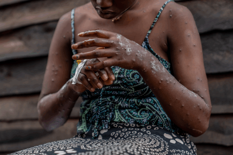 A patient suffering from mpox, sits on a bench at the Kavumu hospital, 30 km north of Bukavu in eastern Democratic Republic of Congo, August 24, 2024. South Kivu province has recorded more than 5,000 cases of monkey pox since the beginning of the year. The Miti-Murhesa health zone, where the Kavumu hospital is located, has seen over 800 cases, including 8 deaths, all of them children under the age of 5. The Democratic Republic of Congo is the global epicenter of the epidemic, with over 16,000 cases reported, including more than 500 deaths.