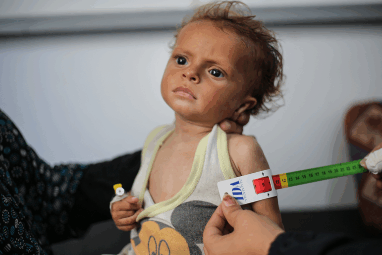 TOPSHOT - A malnourished Palestinian child is examined at Al-Awda hospital in the Nuseirat refugee camp in the central Gaza Strip on June 30, 2025. After more than 20 months of devastating conflict between Israel and the Hamas Islamist militant movement, rights groups say Gaza's population of more than two million face famine-like conditions.