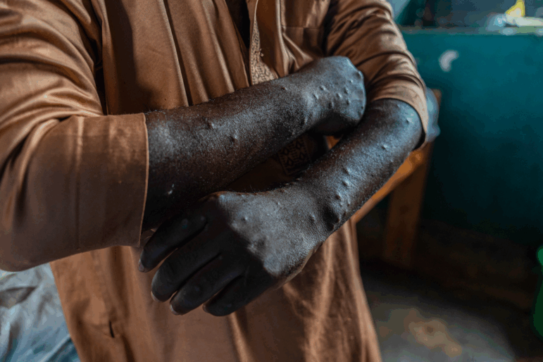 TOPSHOT - A patient infected with mpox shows lesions on his body at the treatment centre in Kamituga, South Kivu province in the east of the Democratic Republic of Congo on September 20, 2024. Kamituga, one of the localities hardest hit by the epidemic with around a thousand confirmed cases, will be one of the first to receive the doses, according to the provincial health authorities. Kamituga, one of the localities hardest hit by the epidemic with around a thousand confirmed cases, will be one of the first to receive the doses, according to the provincial health authorities.