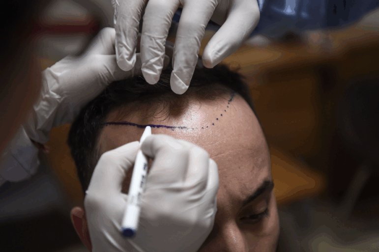 With hundreds of clinics specialized in hair transplants, Istanbul is a growing hub in the industry, attracting people from all over the world.