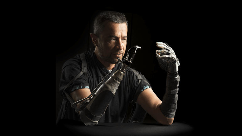 Samoana Matagi was one of the four participants in a study that tested the capabilities of a new bionic hand. Here, Matagi wears the bionic hand on one arm and a common prosthetic called a body-powered hook on the other.