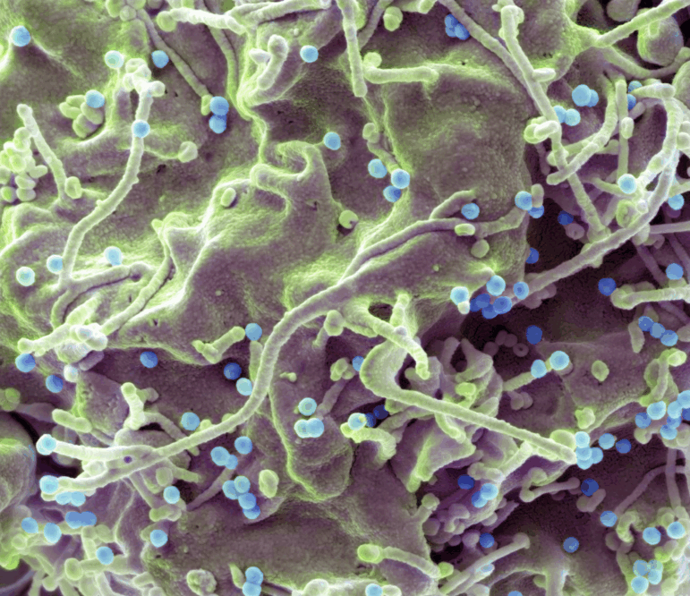 A cell infected wth the human immunodeficiency virus (HIV). This is a color-enhanced scanning electron micrograph image. The drug maker Gilead has announced a new one-a-day pill to keep the virus in check. It's intended for people with HIV who are unable to take other once daily anti-HIV medications and currently are on a multiple-drug regimen.